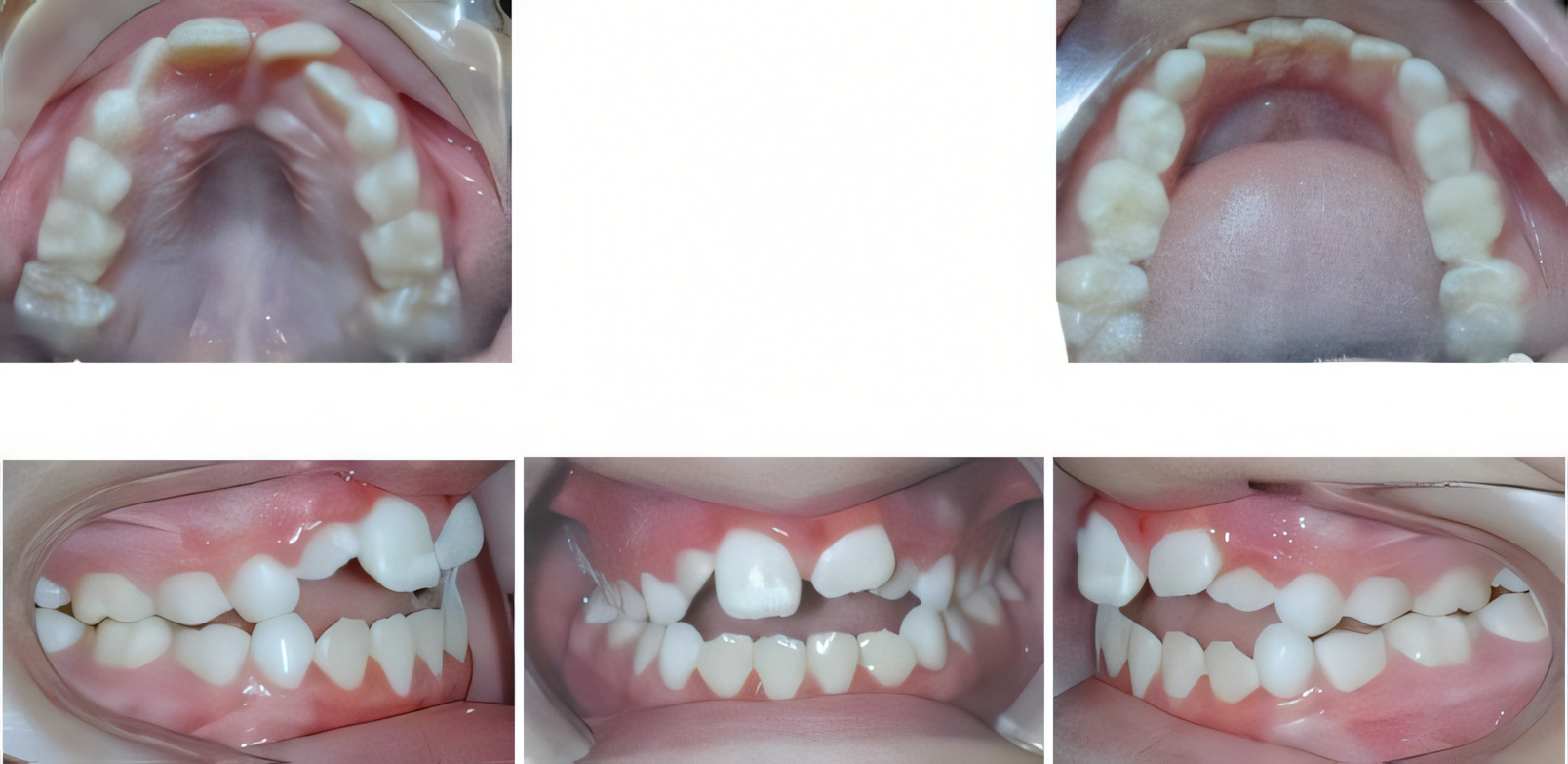 Phase 1 treatment before